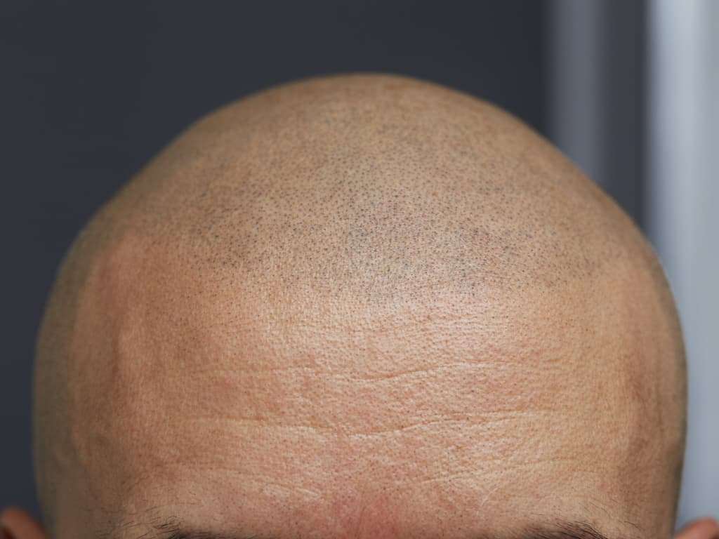 Completed Scalp Micropigmentation Procedure creating the Illusion of a Full Shaved Head of Hair | selftattoo.com