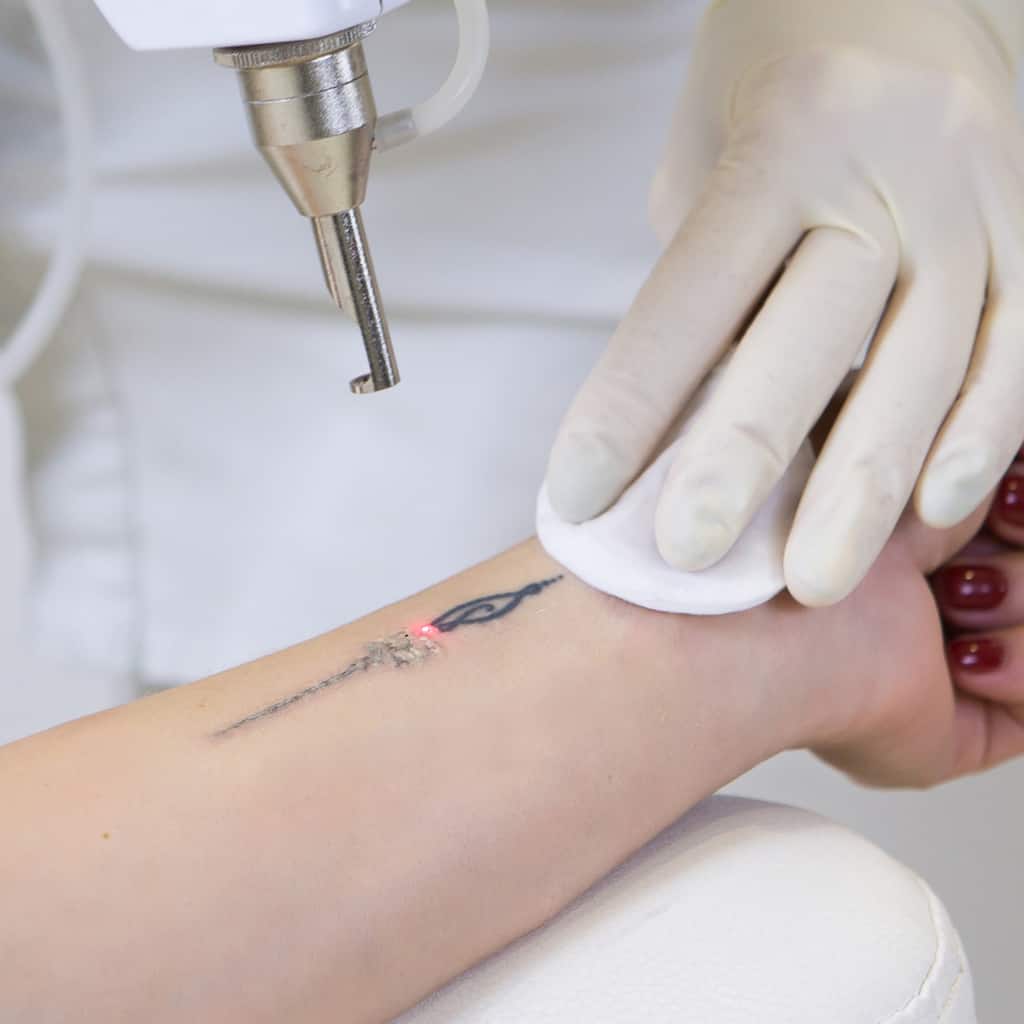 Close-Up of a Person receiving a Laser Tattoo Removal Procedure on a Small Black Forearm Tattoo | selftattoo.com