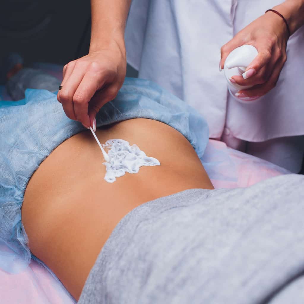 Tattoo Removal Practitioner administering a Skin-Numbing Agent on a Person's Lower Back | selftattoo.com