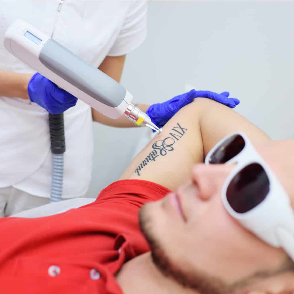 Man Undergoing a Laser Tattoo Removal Procedure on his Upper Arm | selftattoo.com