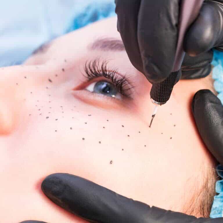 Close-up of a Cosmetic Freckle Tattooing Procedure | selftattoo.com