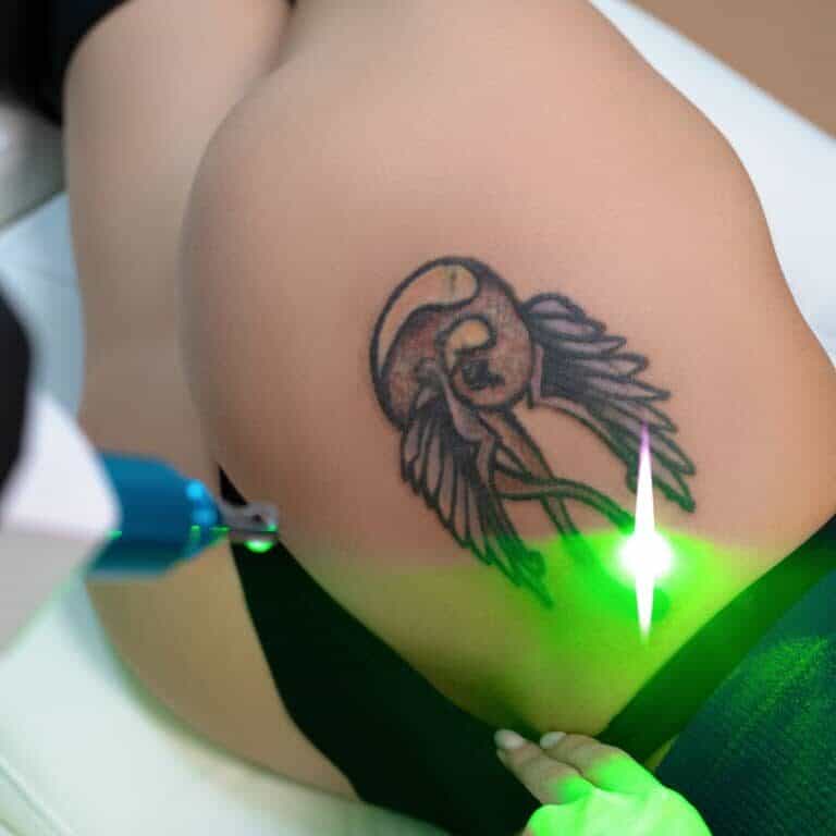 Laser Tattoo Removal Procedure targeting a Hip Tattoo using a Bright Green Laser | selftattoo.com