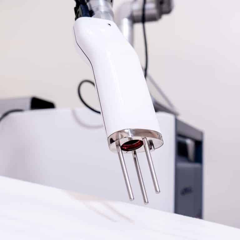 Close-up of a White Laser Tattoo Removal Device with Metallic Prongs | selftattoo.com