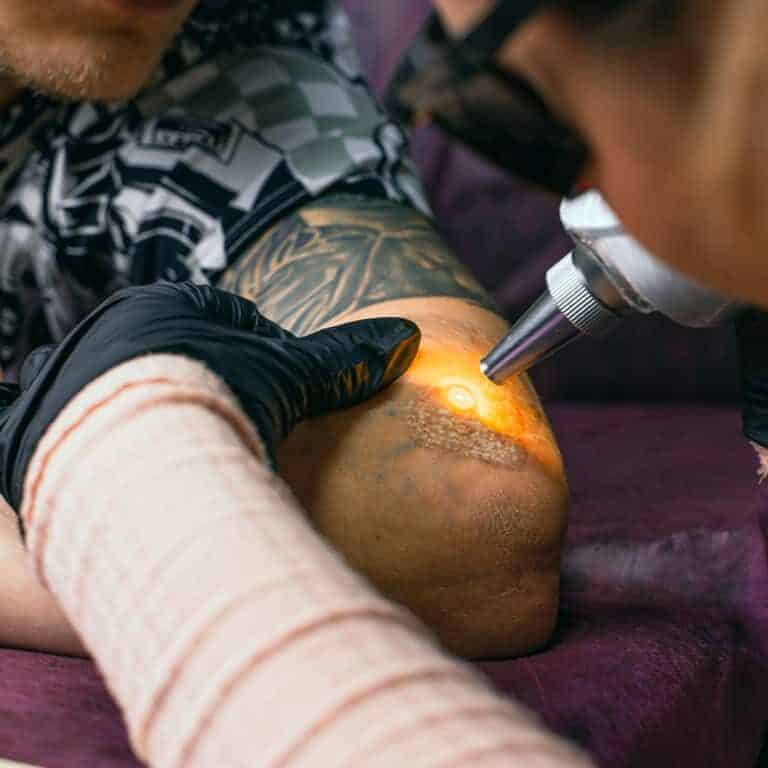 Close-up of a person's arm receiving Laser Tattoo Removal treatment | selftattoo.com