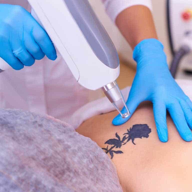 Close-up of a Laser Tattoo Removal Procedure targeting a Black Rose Tattoo | selftattoo.com