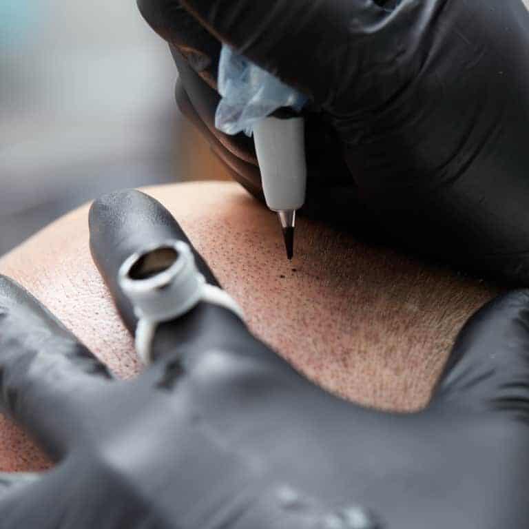 Close-up of a Scalp Micropigmentation Procedure in Progress | selftattoo.com